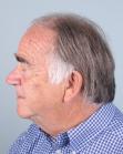 Before Hair Transplant&nbsp;Front